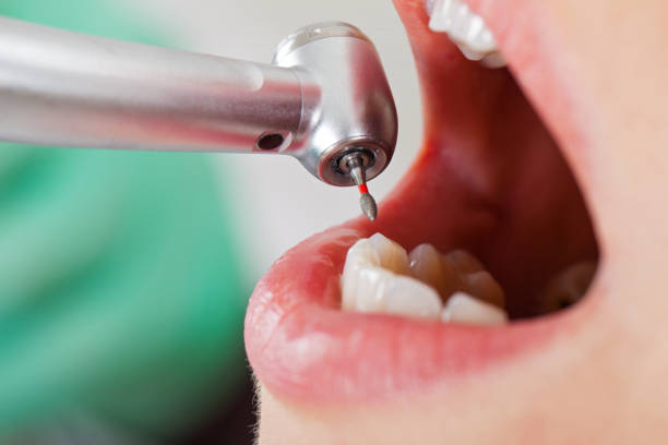 Best Emergency Dentist for Knocked-Out Tooth in Monsey, NY